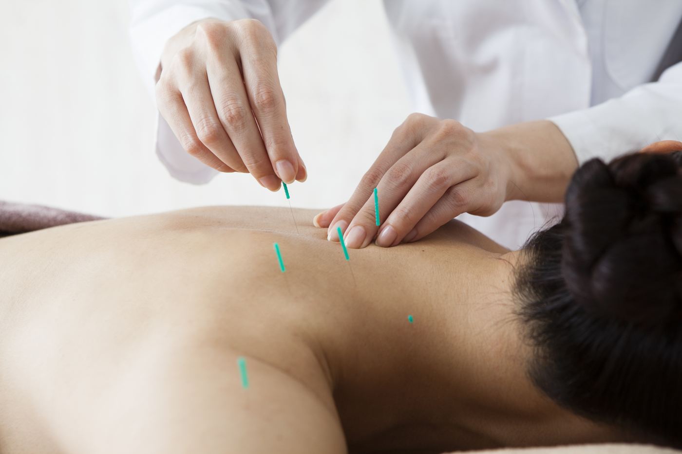 Acupuncture needles placed along a patient's upper back