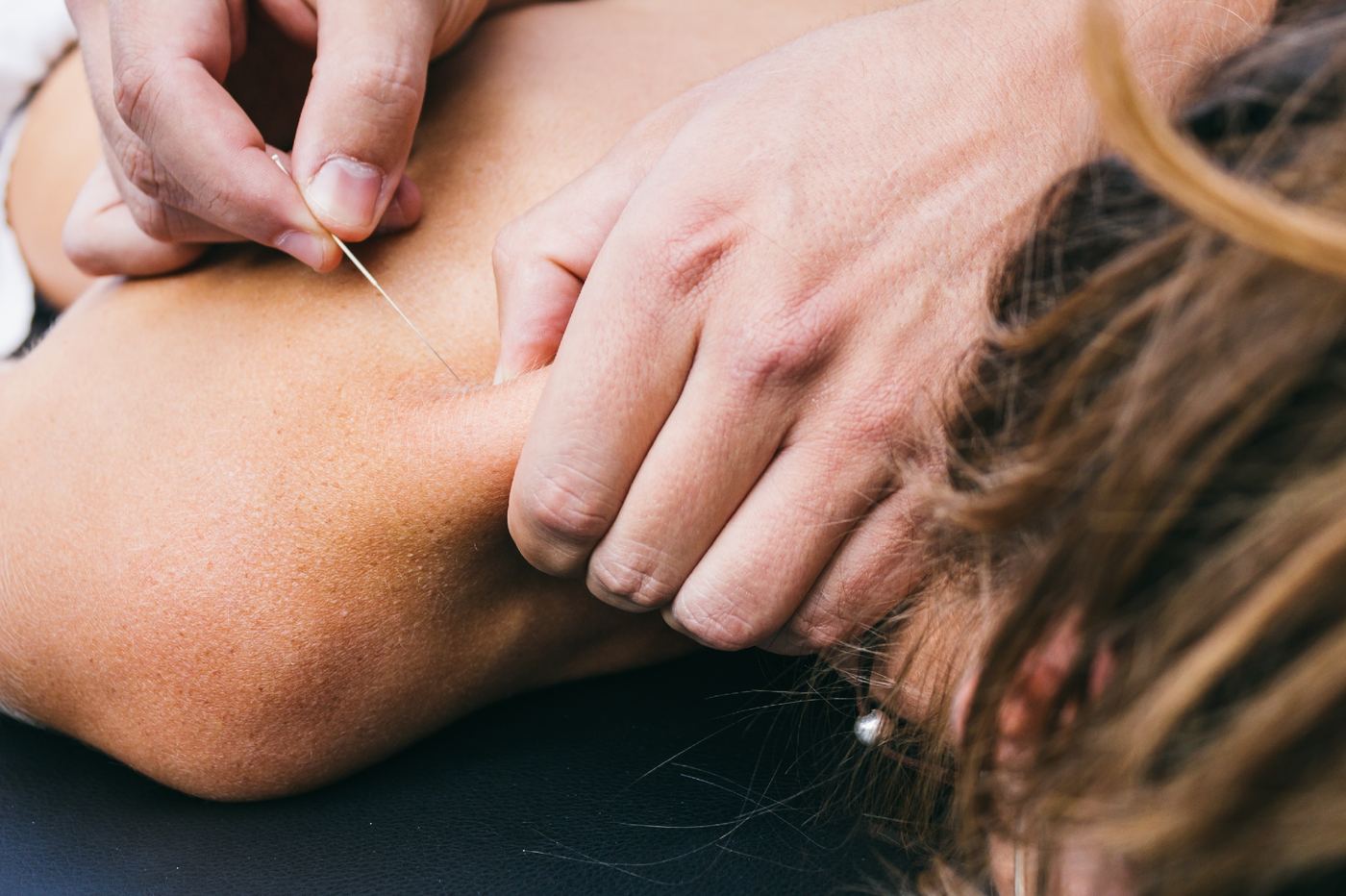 Therapist inserting a fine needle into a tight muscle at the top of the shoulder